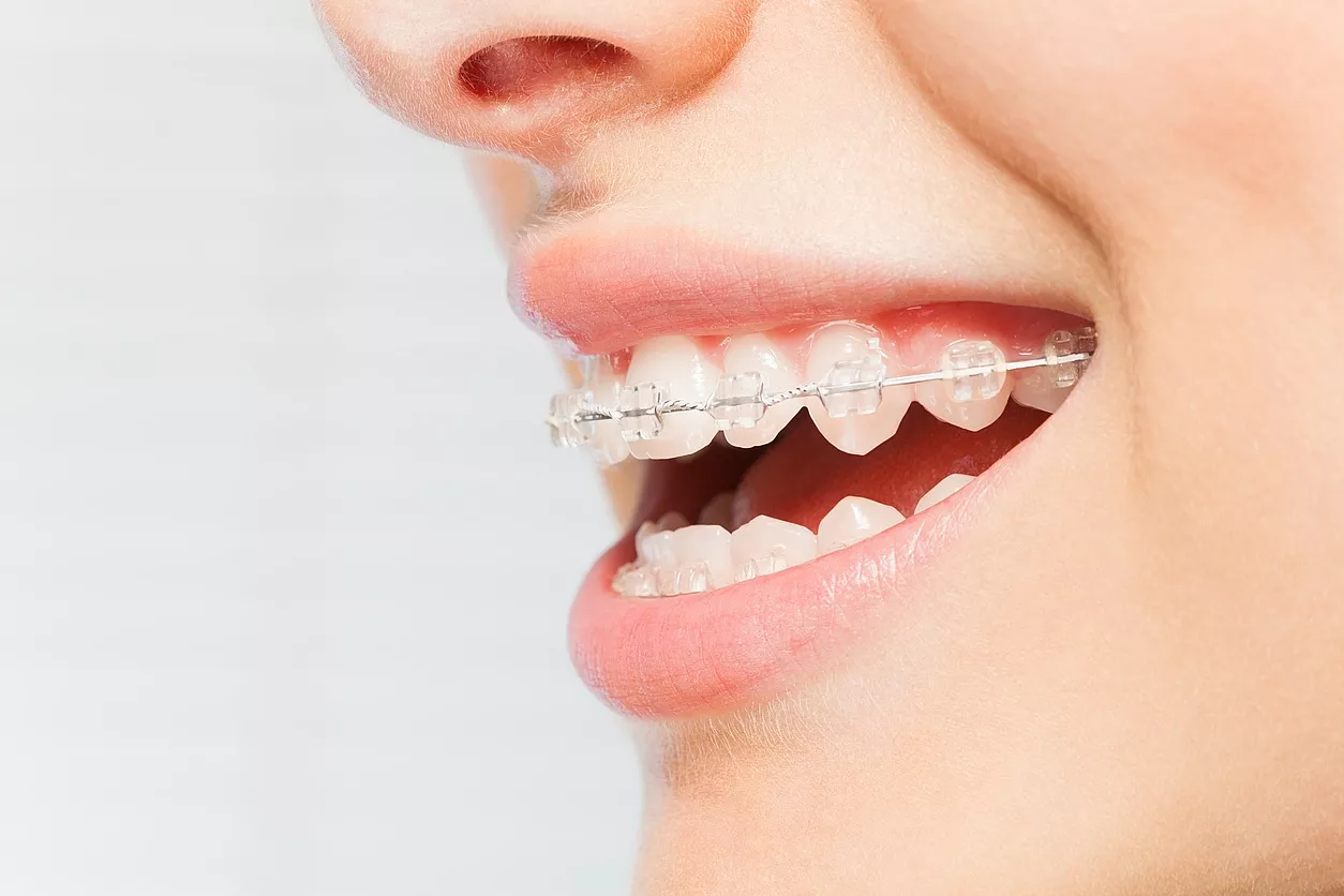 Types of Braces for Adults: Finding the Right Fit