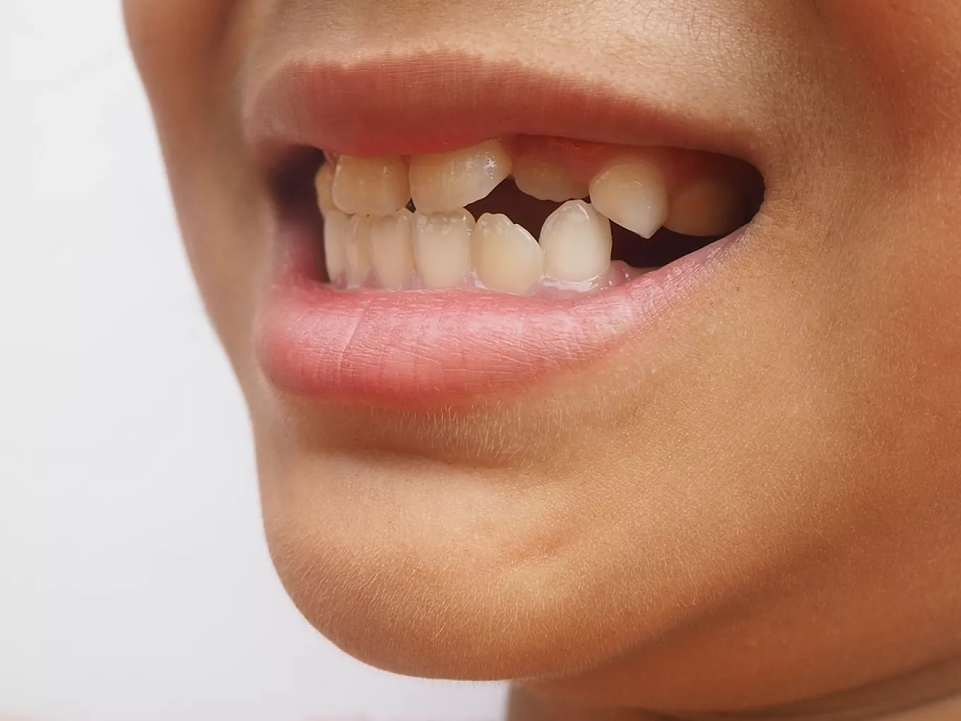 Orthodontists Address Issues Related to Missing or Extra Teeth