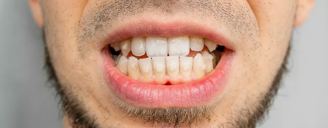 How to Fix an Underbite? Causes & Treatments